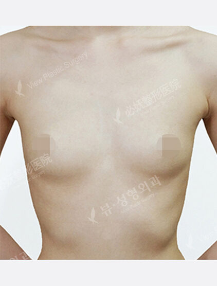 Breast Augmentation ( 1 Year) — Before