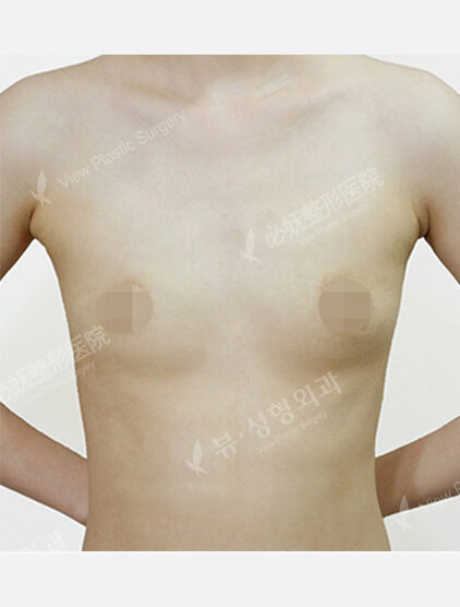 Breast Augmentation ( 5 Months) — Before