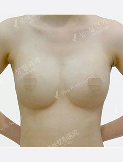 Breast Augmentation ( 5 Months) — After