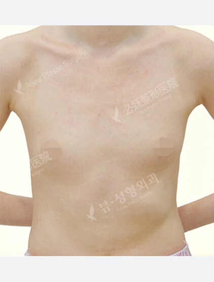 Breast Augmentation ( 6 Months) — Before
