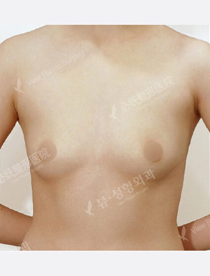 Breast Augmentation (1 Year) — Before