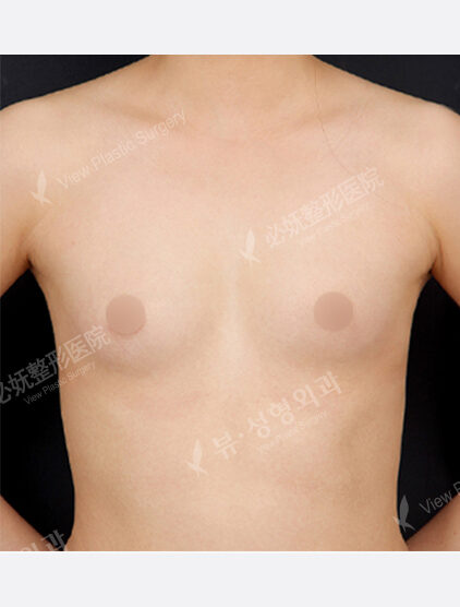 Breast Augmentation (5 Months) — Before