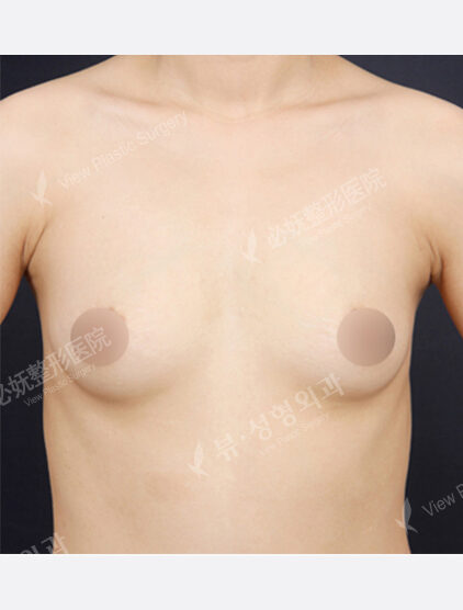 Breast Augmentation (5 Months) — Before