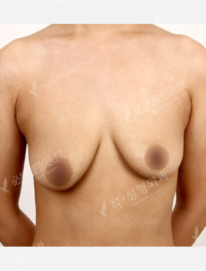 Breast Augmentation+Lifting( 3 Months) — Before