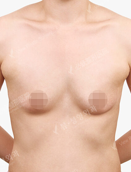 Breast Augmentation (12 Months) — Before