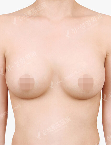 Breast Augmentation (12 Months) — After