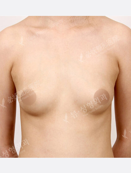 Breast Augmentation (4 Months) — Before