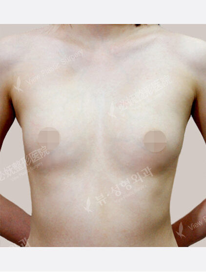 Breast Augmentation (1 Year) — Before