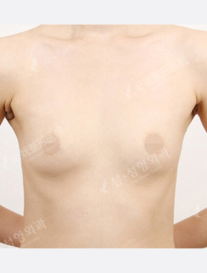 Breast Augmentation (4 Months) — Before