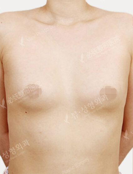 Breast Augmentation (5 Months) — Before