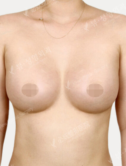 Breast Augmentation (5 Months) — After