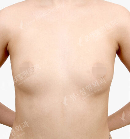 Breast Augmentation (6 Months) — Before