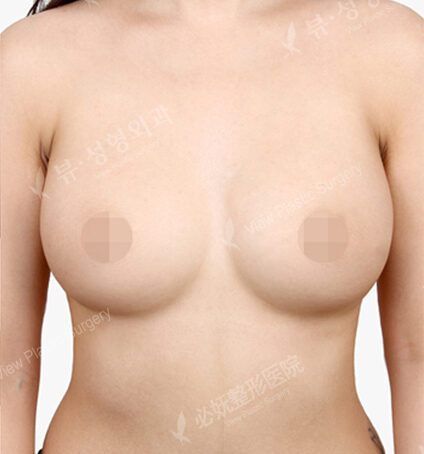 Breast Augmentation (6 Months) — After