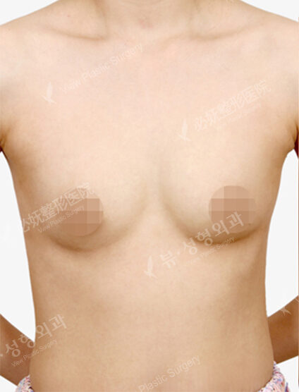 Breast Augmentation (6 Months) — Before