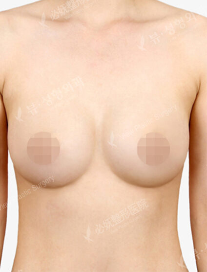 Breast Augmentation (6 Months) — After