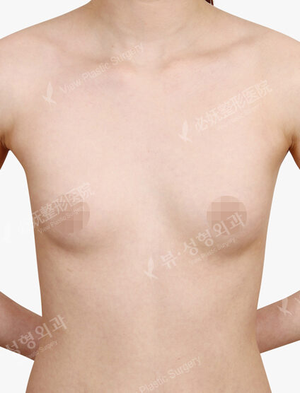 Breast Augmentation (10 Months) — Before