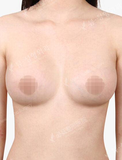 Breast Augmentation (10 Months) — After