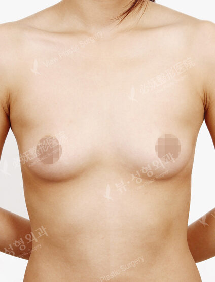 Breast Augmentation (5 Months) — Before