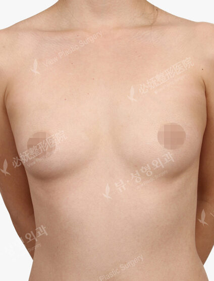 Breast Augmentation (10 Months) — Before