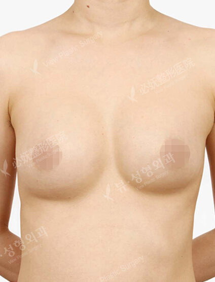 Revisional Breast Surgery (5 Months) — Before