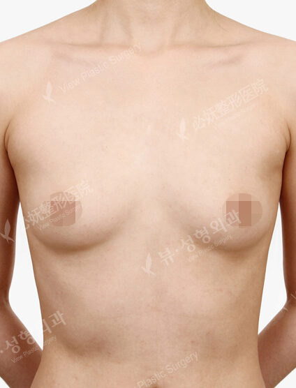 Breast Augmentation ( 2 Months) — Before