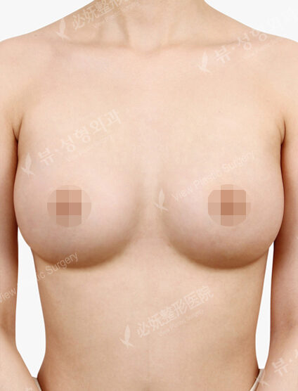 Breast Augmentation ( 2 Months) — After