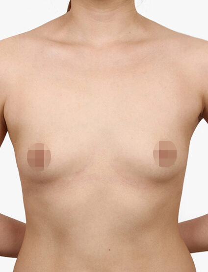 Breast Augmentation ( 8 Months) — Before