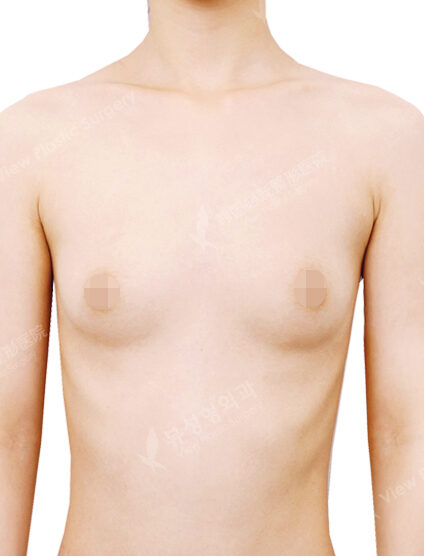 Breast Augmentation (3 Months) — Before