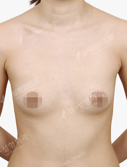 Breast Augmentation ( 4 Months) — Before
