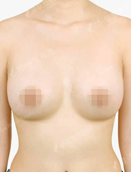 Breast Augmentation ( 4 Months) — After