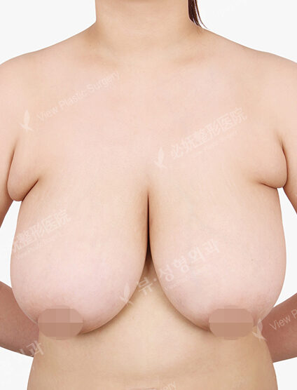 Breast Reduction (6 Months) — Before