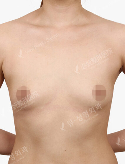 Breast Augmentation ( 6 Months) — Before