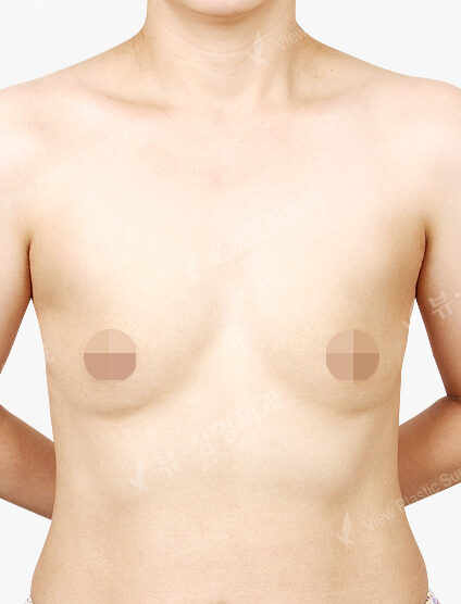Tear Drop Breast Augmentation(4 Months) — Before