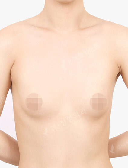 Breast Augmentation (9 Months) — Before