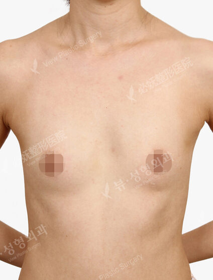 Breast Augmentation Tear Drop( 1 Months) — Before