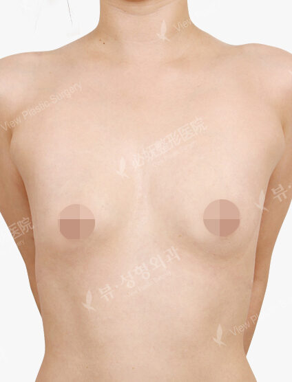 Breast Augmentation Tear Drop (4 Months) — Before