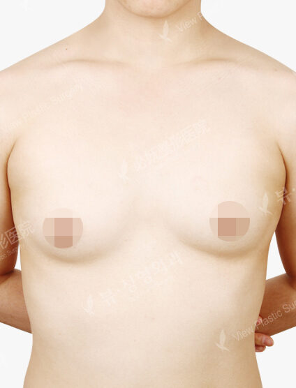 Breast Augmentation (6 Months) — Before