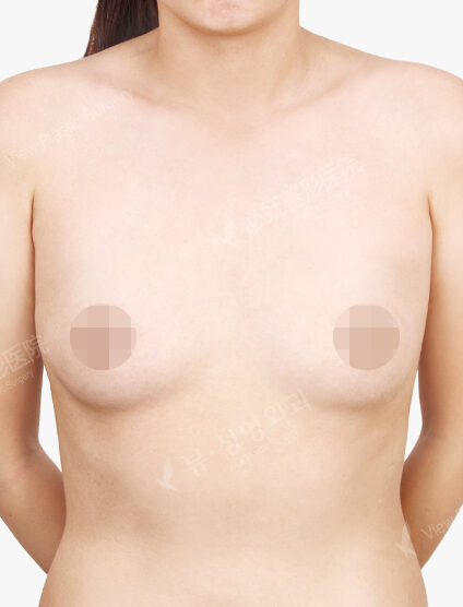 Breast Augmentation (11 Months) — Before