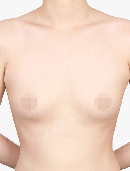 Breast Augmentation (6 Months) — Before