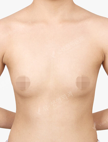 Breast Augmentation (6 Months) — Before