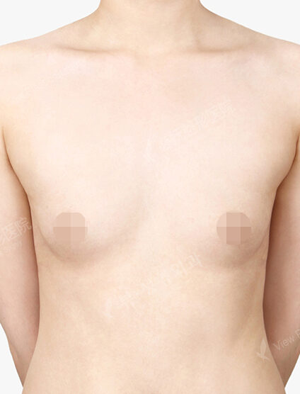 Breast Augmentation+Accessory Breast (18 Months) — Before