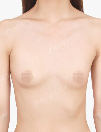 Breast Augmentation (16 Months) — Before