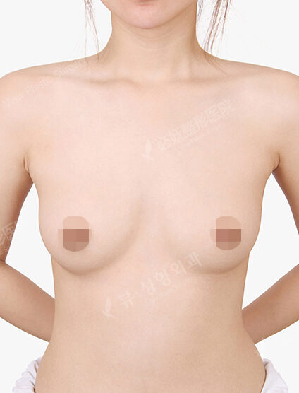 Breast Augmentation (9 Months) — Before