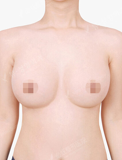 Breast Augmentation (9 Months) — After