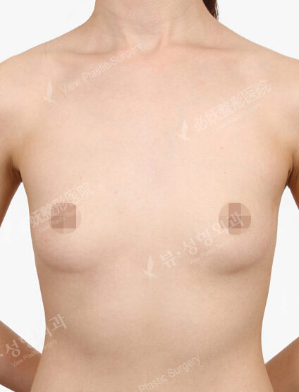 Breast Augmentation Tear Drop( 3 Months) — Before