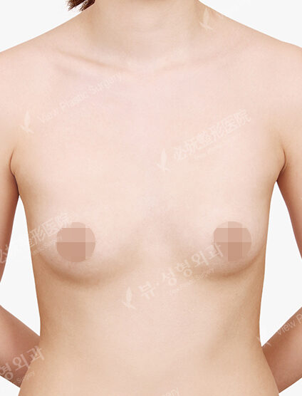 Breast Augmentation Tear Drop (6 Months) — Before