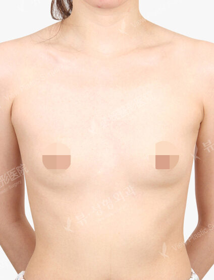 Breast Augmentation Tear Drop(5 Months) — Before