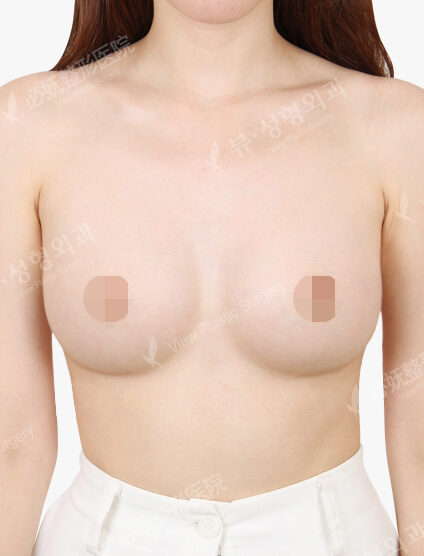 Breast Augmentation Tear Drop(5 Months) — After