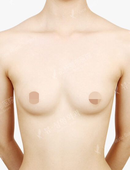 Breast Augmentation Tear Drop (3 Months) — Before