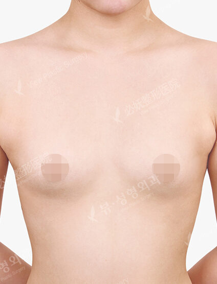 Breast Augmentation (12 Months) — Before